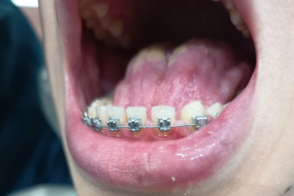 Niềng Răng Thẩm Mỹ Tại Đồng Xoài: Lộ Trình Kiến Tạo Nụ Cười Hoàn Hảo